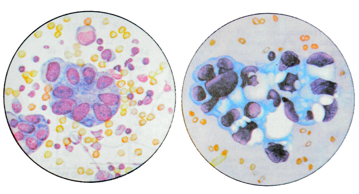 Недифференцированные клетки в общем анализе крови